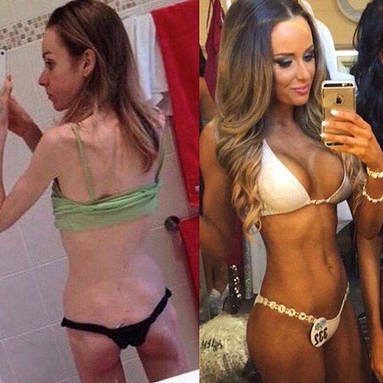 Anorexic with silicone breasts