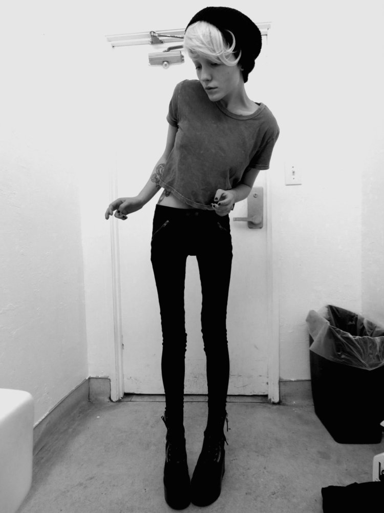 Alice Glinsky anorexics