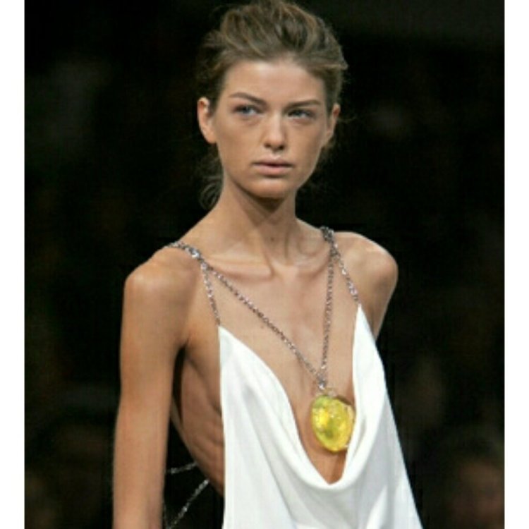 Natalya Guzzi Anorexia