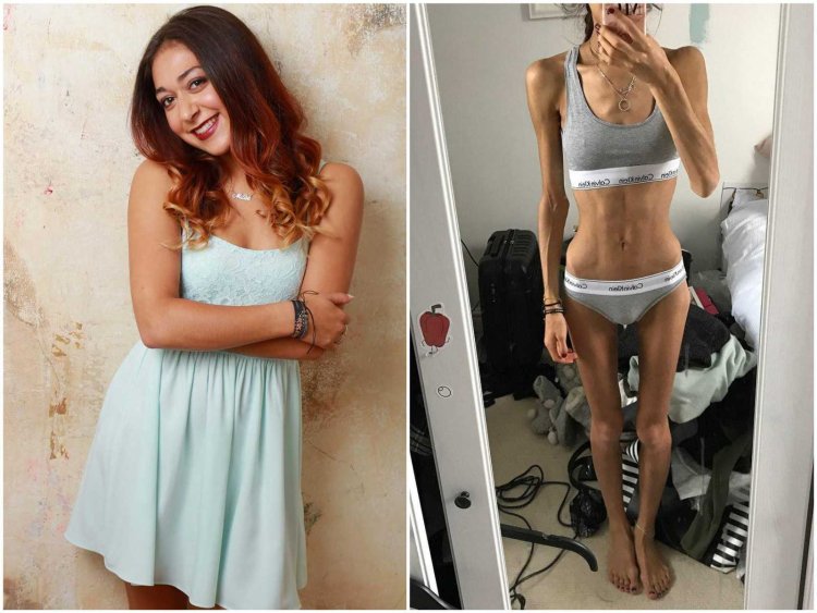 Anastasia Solomatina Anorexia