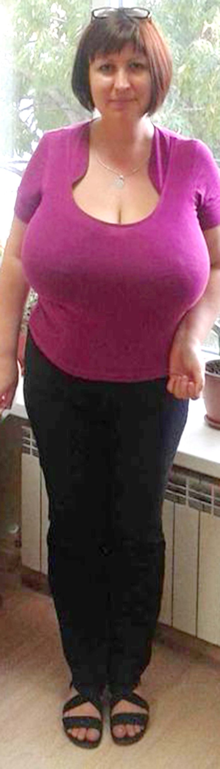 Macromastia in elderly women