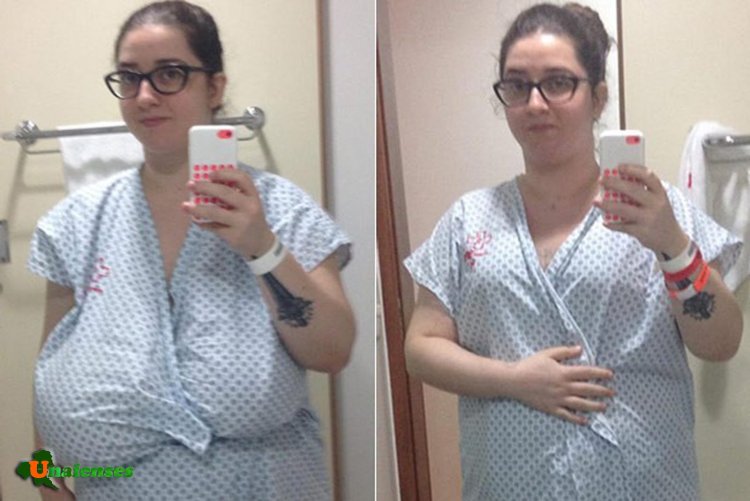 Gigantomastia before and after surgery