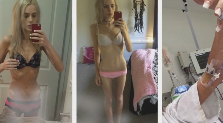Khilkevich Anna Anorexia Anorexia
