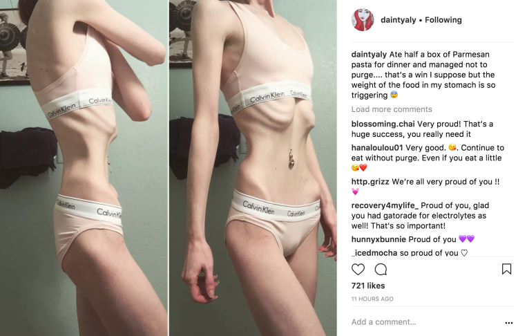 Nuel Knightley anorexia