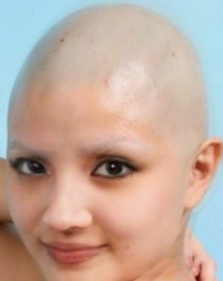 Bald woman without eyebrows