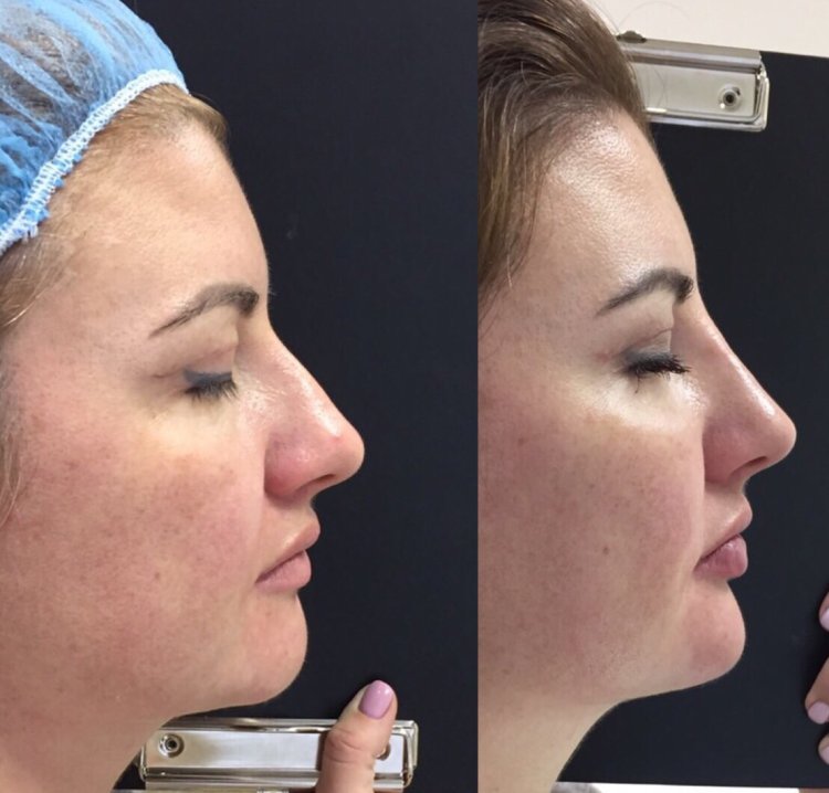 Non -surgical rhinoplasty advertising