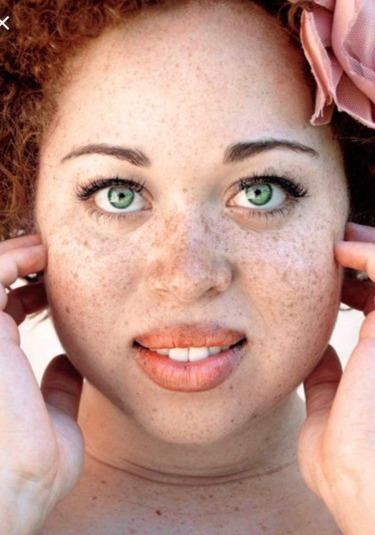 People with acne and freckles