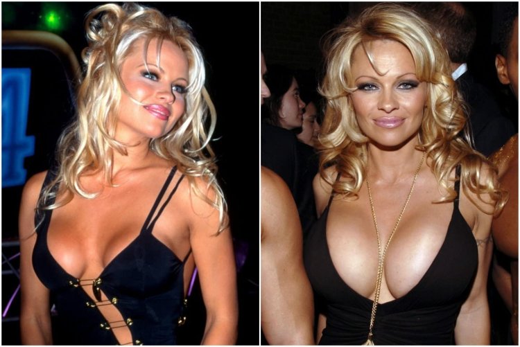 Pamela Anderson Silicone