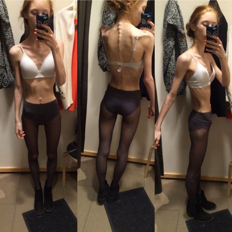 Anorexic in lingerie