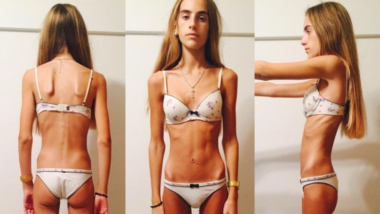 Sarah Spencer anorexia