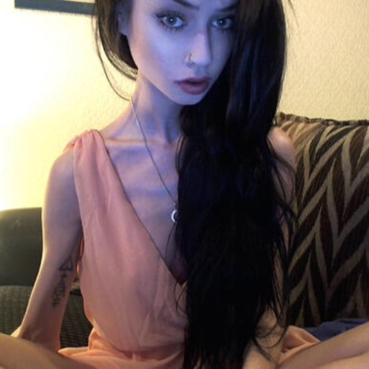 Felice Fawn anorexia