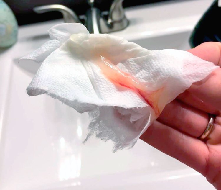 Mucus with blood streaks