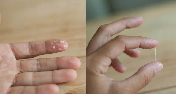 Excretion FII thrush