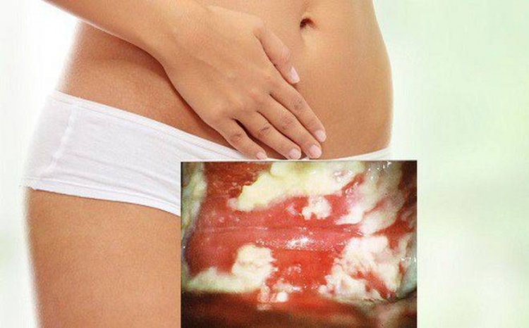 Vulvovaginal candidiasis