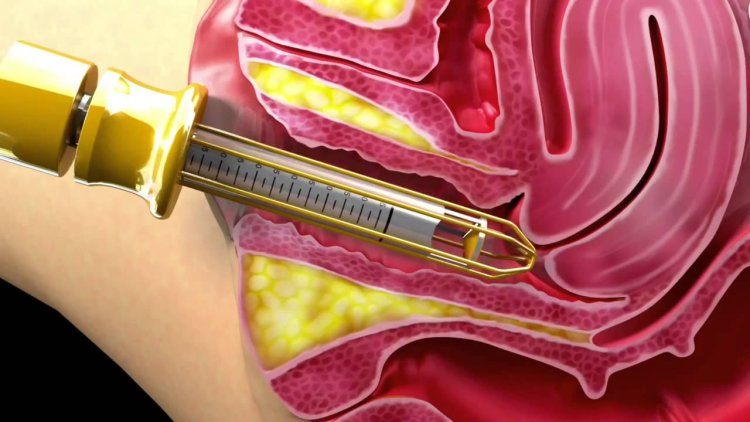 Laser rejuvenation in gynecology