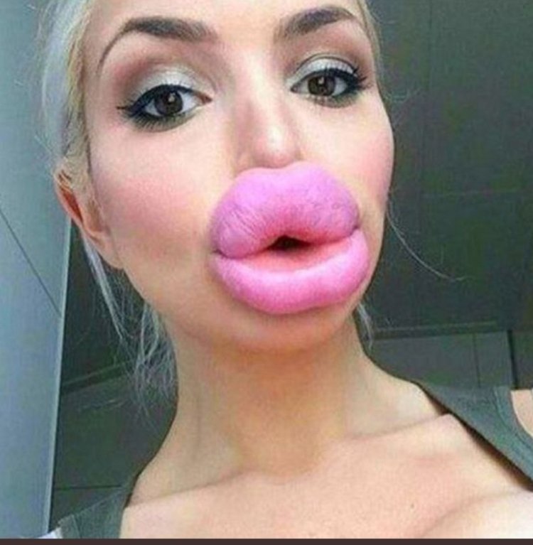 Duck lips