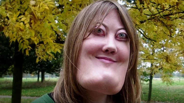 Victoria Wright Cherubism