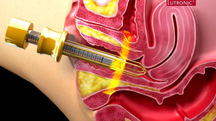 Surgitron for stretching the vagina