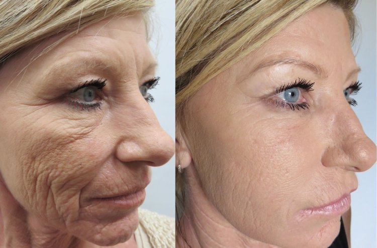 Wrinkles before after