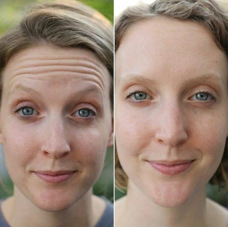 Wrinkles before after