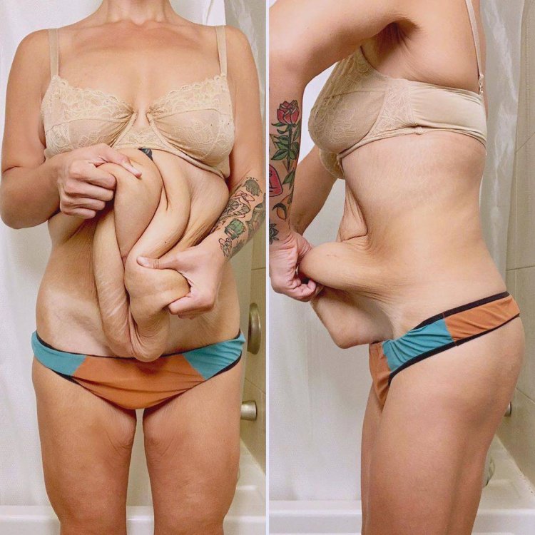 Sagging skin after weight loss