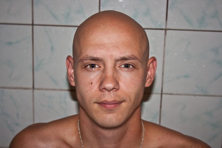 Bald teenager