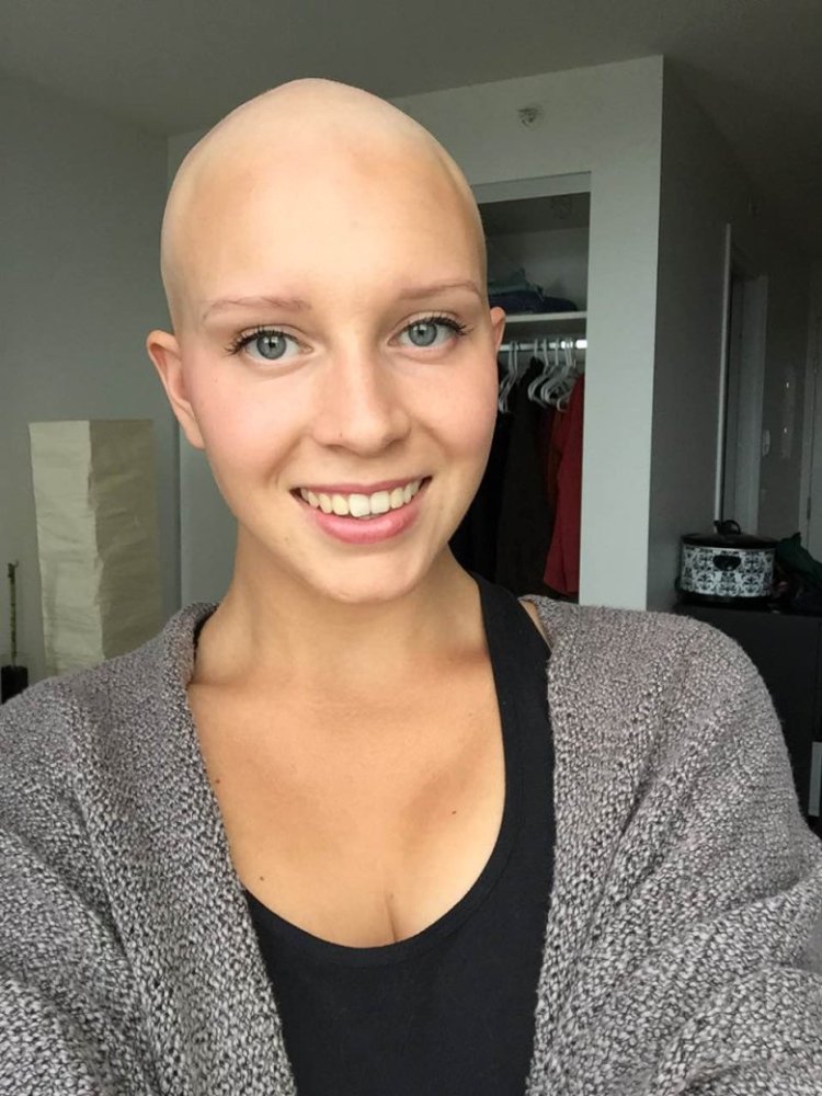 Natasha Whiteman is bald
