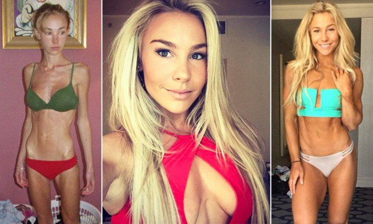 Anorexic with silicone breasts