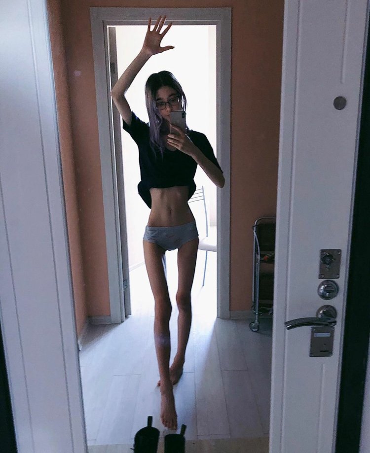 Anastasia Solomatina anorexia