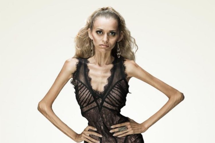 Anorexia Nervosa Jessica Parker