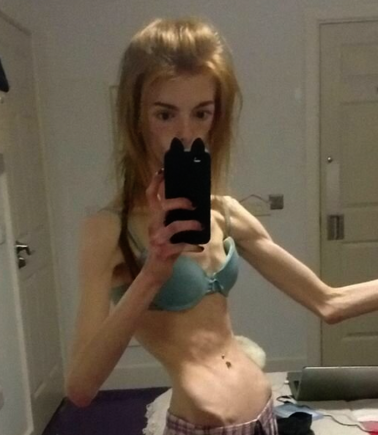 Dying girls from anorexia