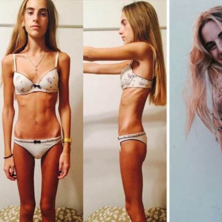 Varvara Borodina anorexia