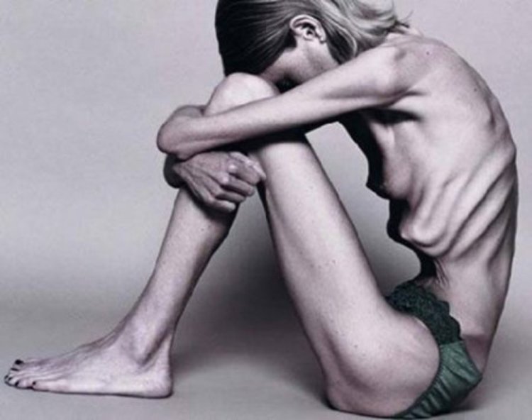 Cachectic anorexia