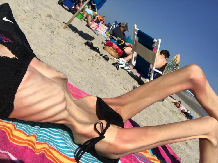 Margarita Aslanyan anorexia