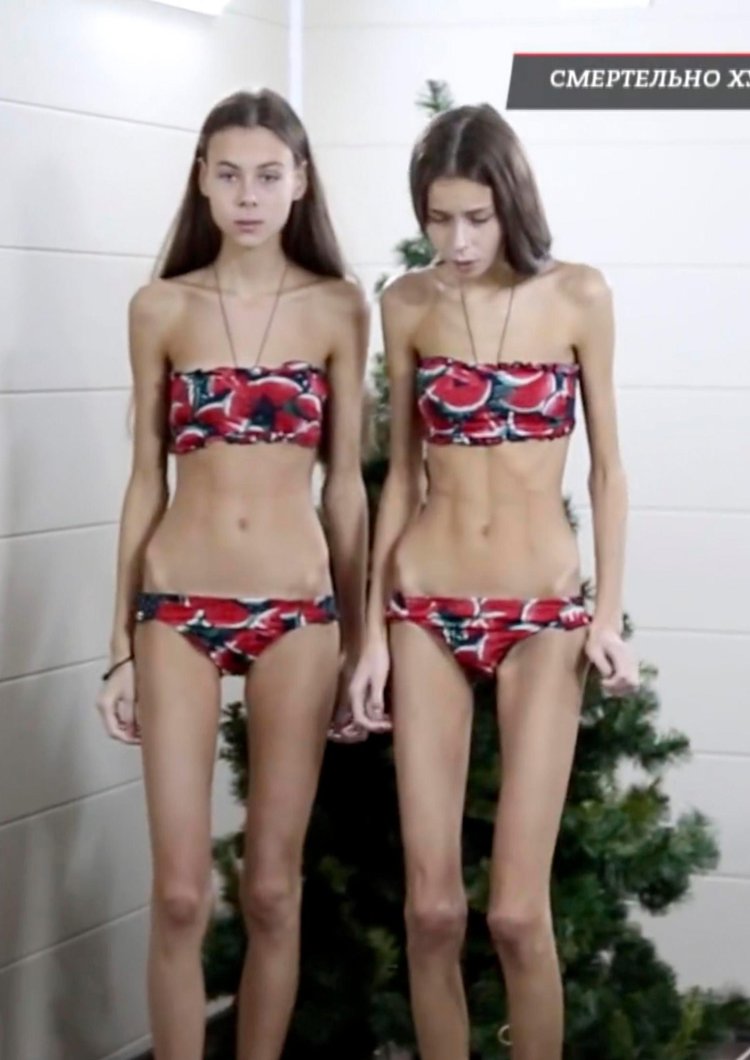Anorexic twins Dasha and Masha