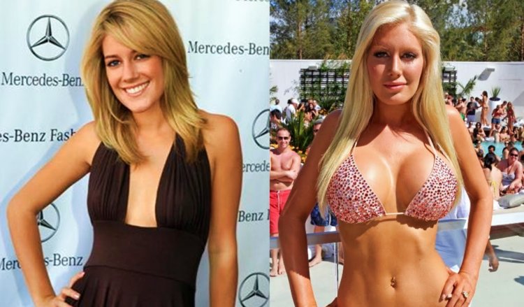 Heidi Montag after plastic surgery