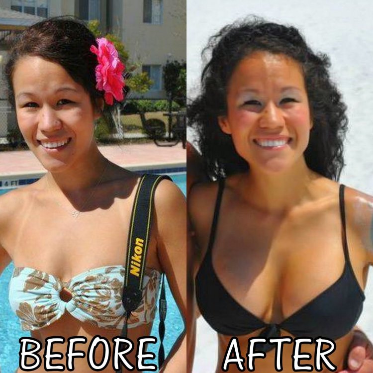 Women with enlarged breasts before and after