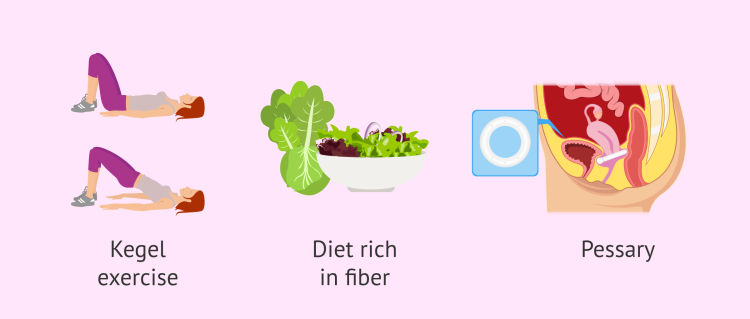 Prolapse Kerrigan prolapse