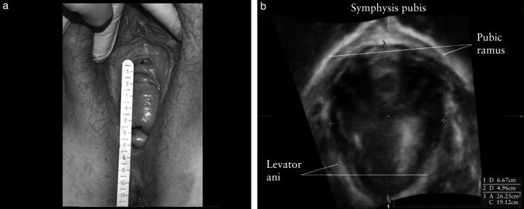 Uterovaginal prolapse