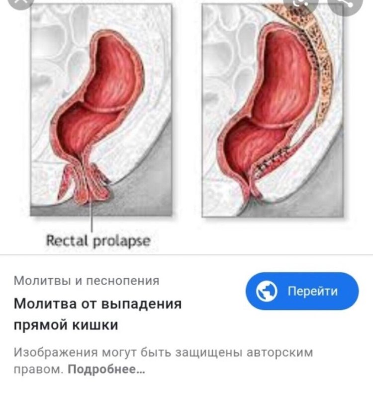 Rectal prolapse in women