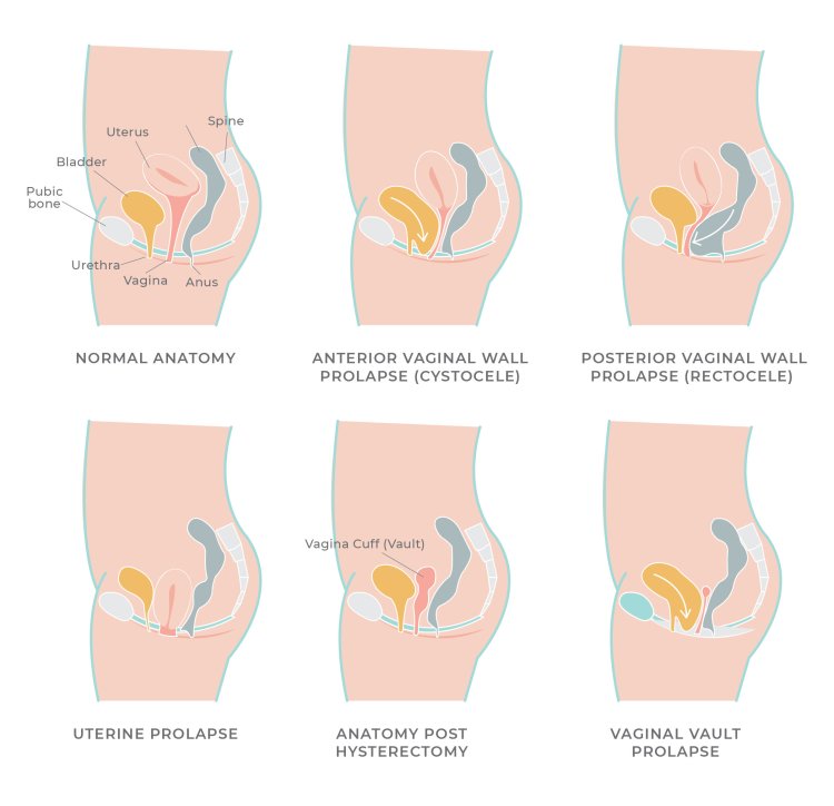 Anal prolapse in the toilet