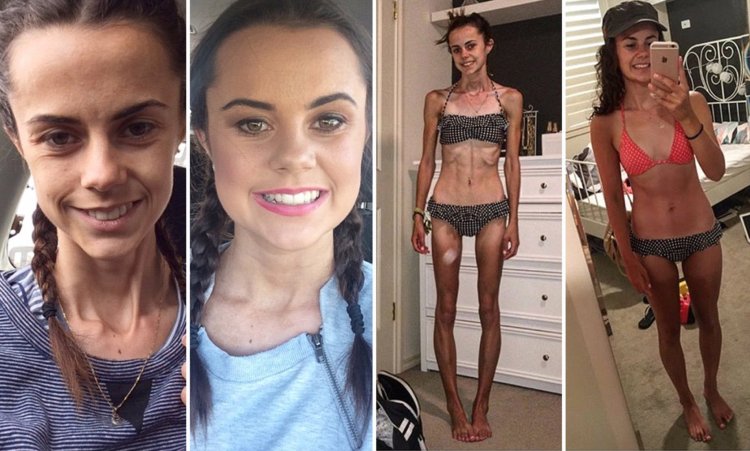 Anorexia before and after weight loss