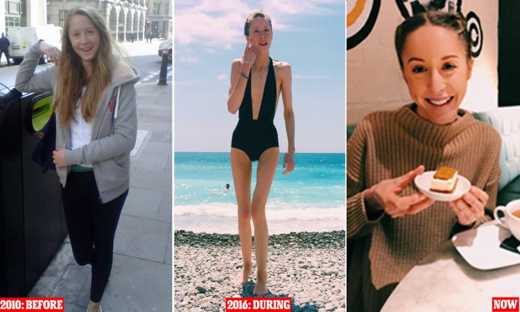 Daria Parkhomenko anorexia