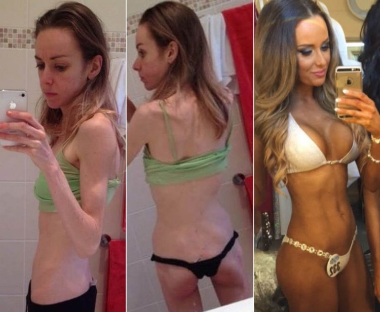 Caitlin Davidson anorexia