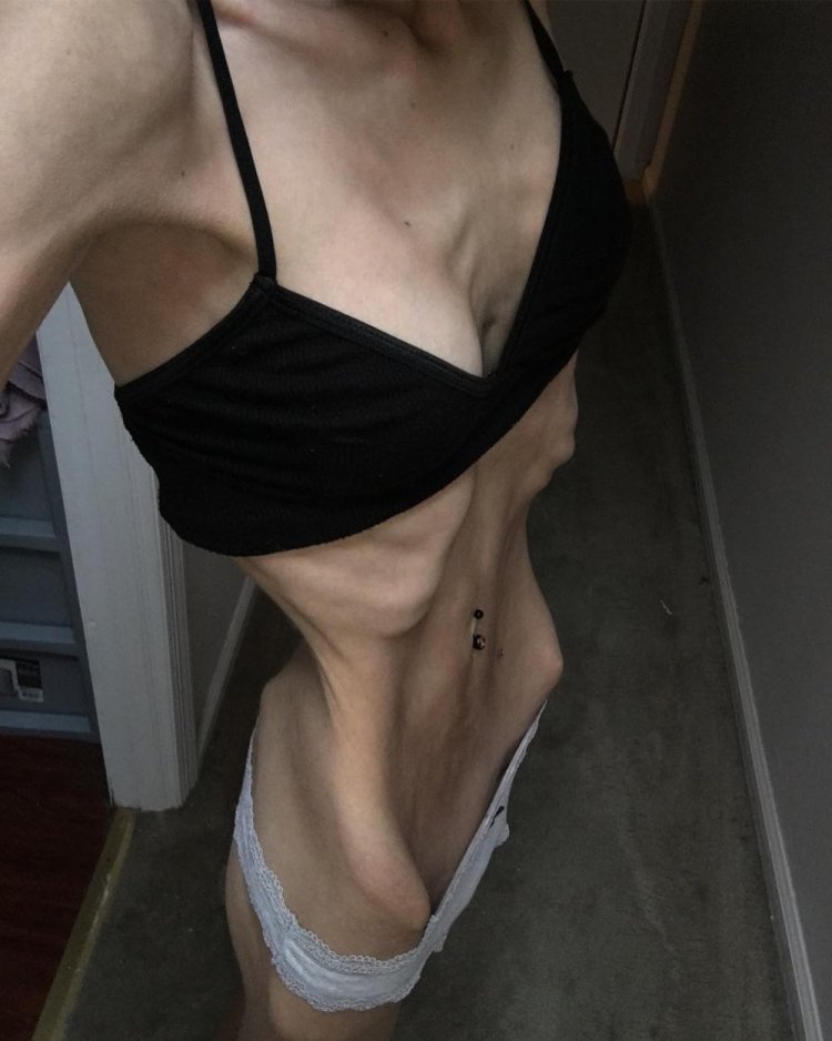 Brittany Robinson anorexia