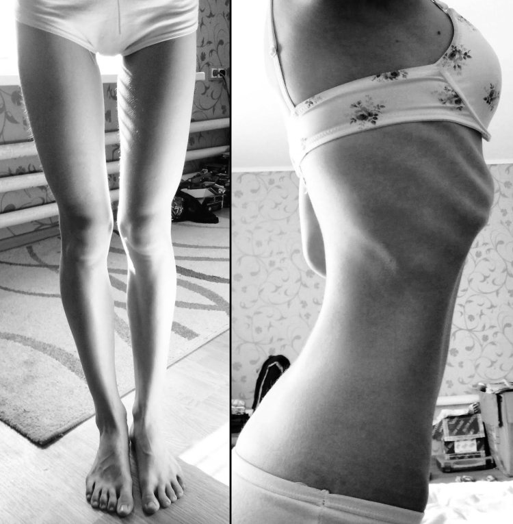 Beautiful anorexia