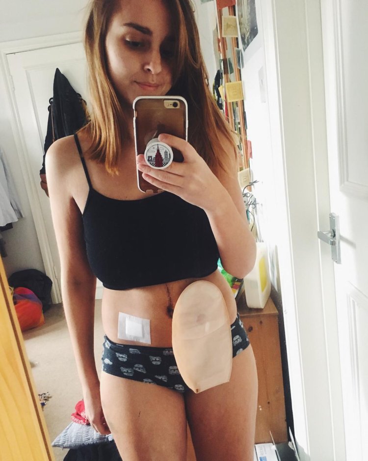Photo session of a girl with a colostomy bag