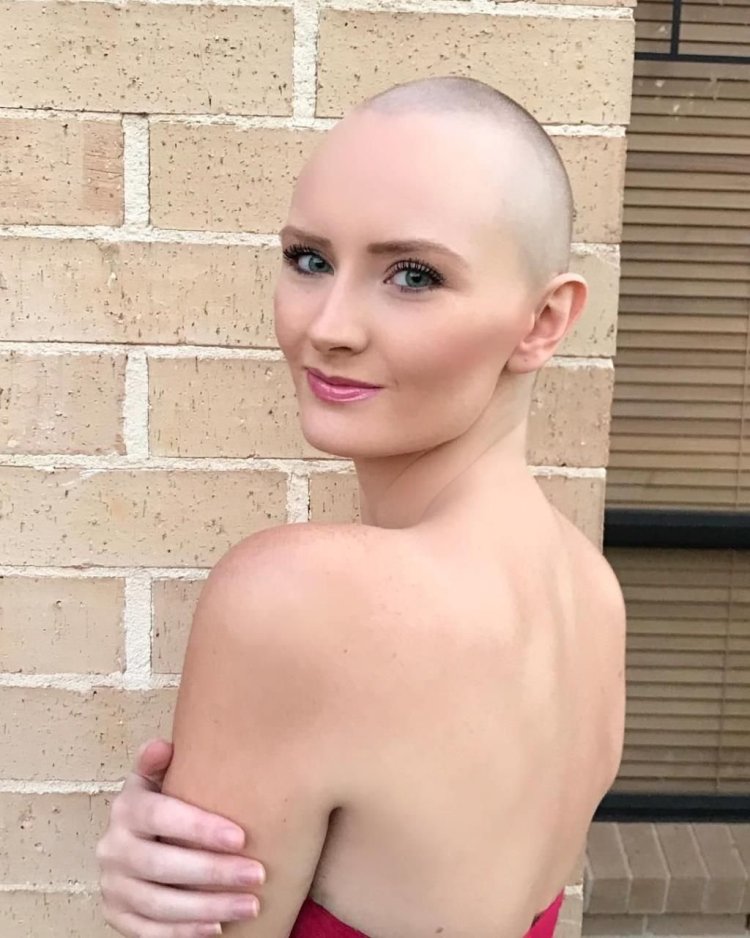 Natasha Whiteman is bald