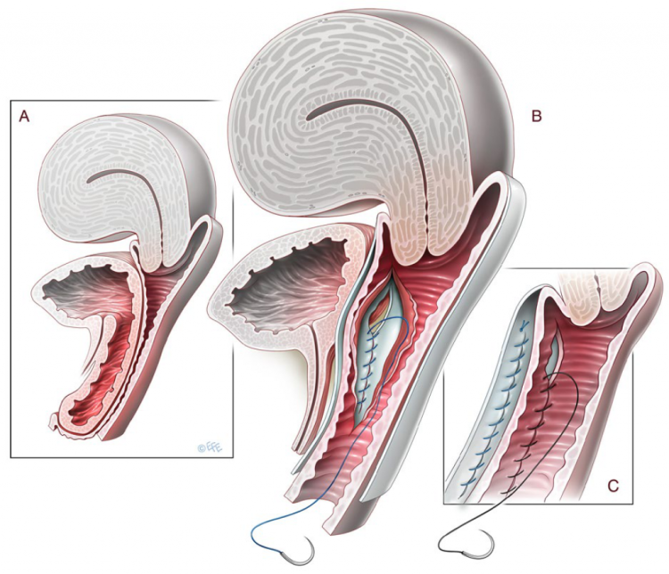 Subfascial colporrhaphy