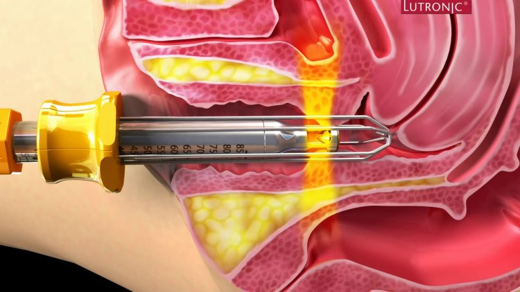 Photon laser gynecology